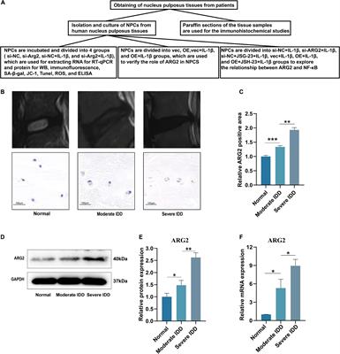 Arginase II Promotes Intervertebral Disc Degeneration Through Exacerbating Senescence and Apoptosis Caused by Oxidative Stress and Inflammation via the NF-κB Pathway